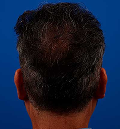 después de realizar el implante de pelo