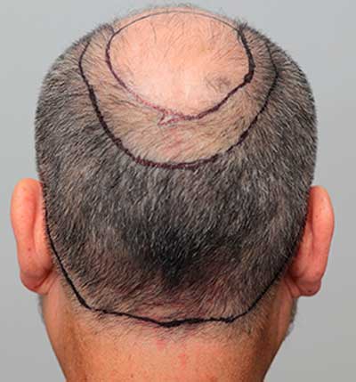 implantes-pelo-antes antes de realizar el implante de pelo