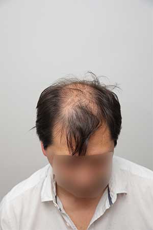 Antes