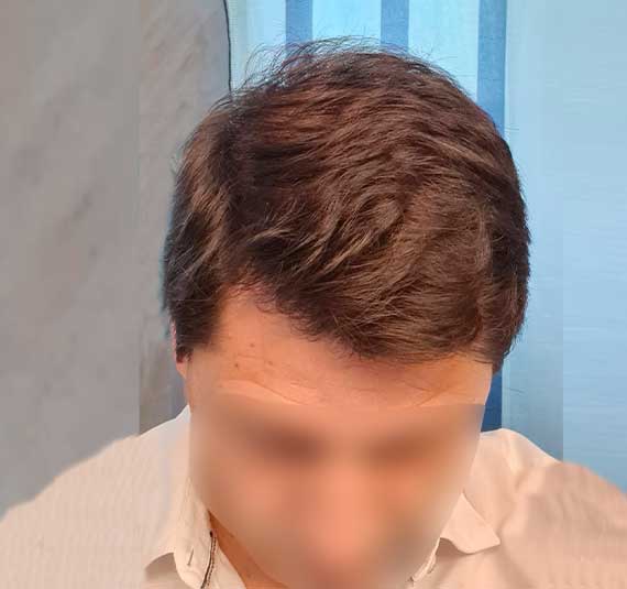 casosdeexito-implante-fue-04