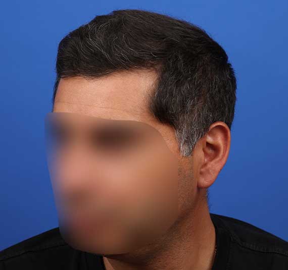 implante-capilar-fue-casos-exito-despues02