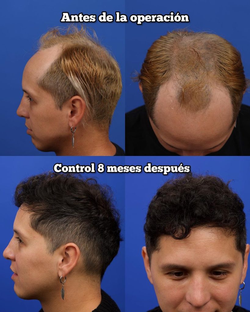 evolucion del implante capilar del influencer holasoycabezon